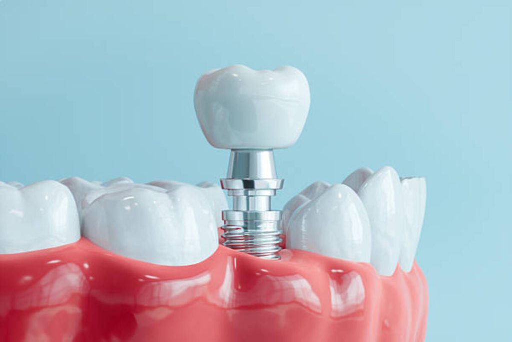 common dental implant mistakes