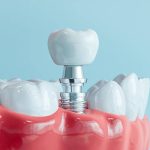 common dental implant mistakes