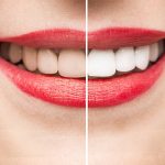 how teeth whitening works scientifically