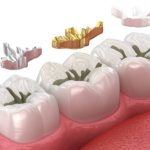 Why Does My Tooth Hurt Weeks After A Cavity Filling?