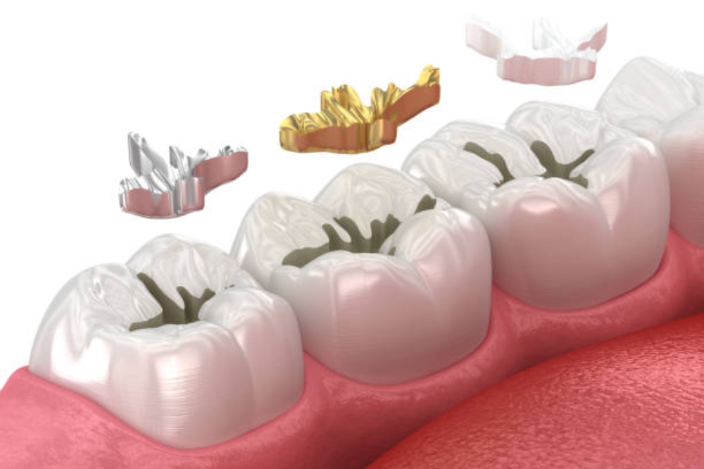 Why Does My Tooth Hurt Weeks After A Cavity Filling?