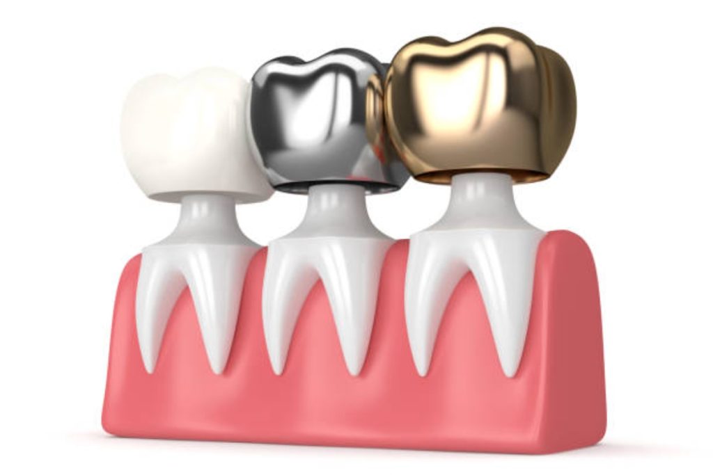 how to choose the right dental crown