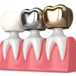 how to choose the right dental crown