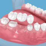 Dental Bridges Explained: How They Restore Missing Teeth