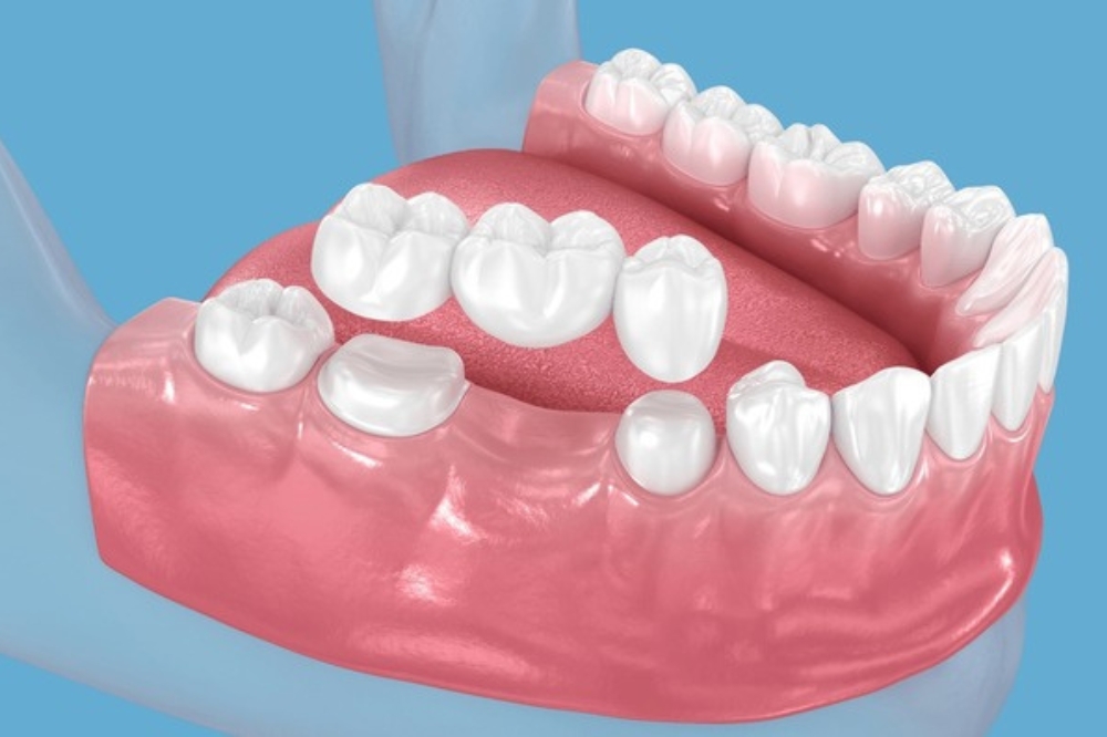 Dental Bridges Explained: How They Restore Missing Teeth
