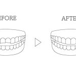 is dental bonding a good alternative