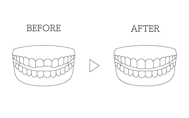 is dental bonding a good alternative